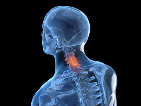 3d rendered illustration of an inflamed neck