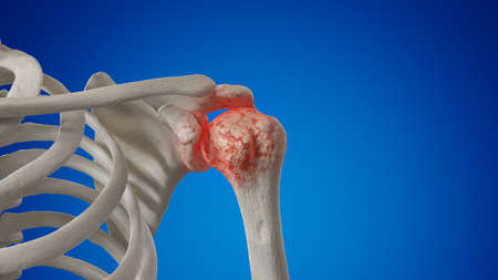 3d rendered illustration of an arthritic shoulder joint