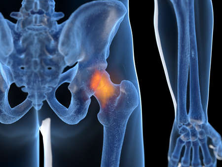 3d rendered illustration of an inflamed hip jointの写真素材