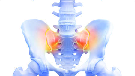 3d rendered illustration of a painful sacroiliac joint