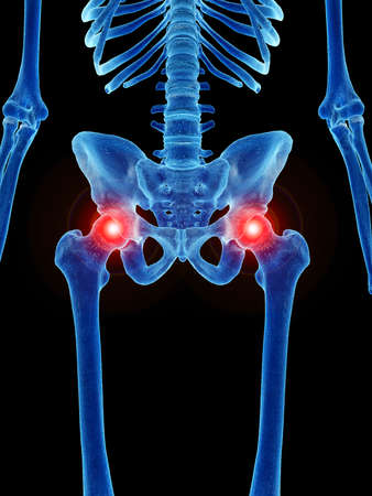 3d rendered illustration of painful hip jointsの写真素材