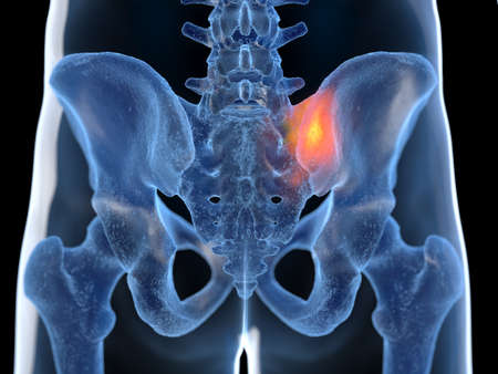 3d rendered illustration of a painful sacroiliac jointの写真素材