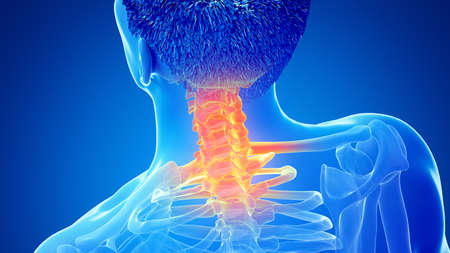 3d rendered illustration of a painful cervical spine