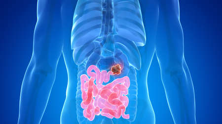 3d rendered medically accurate illustration of small intestine cancer