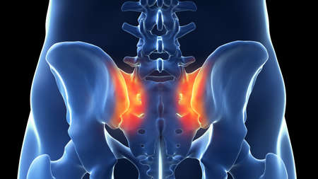 3d rendered illustration of a painful sacroiliac joint
