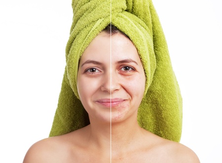 Woman with spotty skin with deep pores and blackhead and healed soft skin 