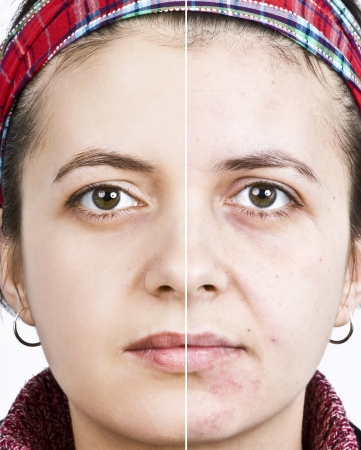 Woman with spotty skin with deep pores and blackhead and healed soft skin の写真素材