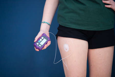Close up view of a diabetic child with an insulin pump.Child diabetes concept.の写真素材