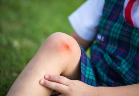 Close up on an bleeding scraped kid's knee. Children injury - painful knee wound accident.の写真素材