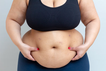 Obese young woman holds her belly recently operated on from sleeve bariatric surgery.の写真素材