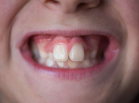 Problems with the teeth of a young boy. Not the correct bite.