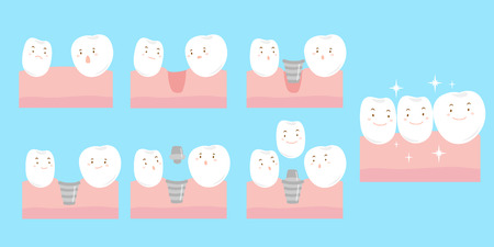 cute cartoon tooth implant smile happily with gumのイラスト素材