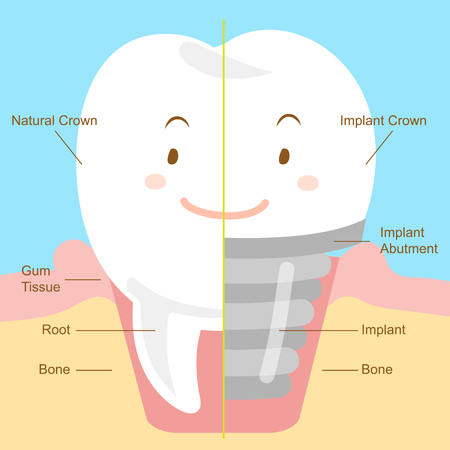 Cute cartoon tooth with implant on blue backgroundのイラスト素材