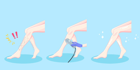 Woman leg hair removal on the blue backgroundのイラスト素材