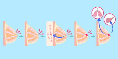 cartoon breast cancer on the blue backgroundのイラスト素材