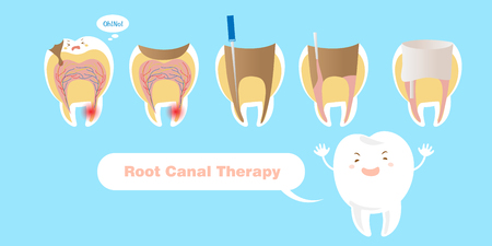tooth with root canal therapy on the blue backgroundのイラスト素材