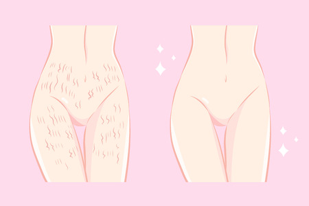 Woman with stretch mark skin before and after illustration.のイラスト素材