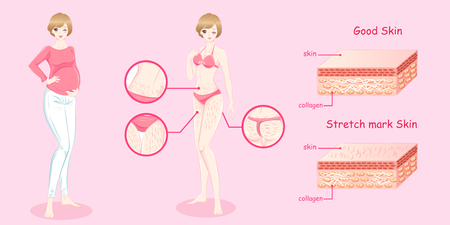 Woman with stretch mark skin on the pink backgroundのイラスト素材