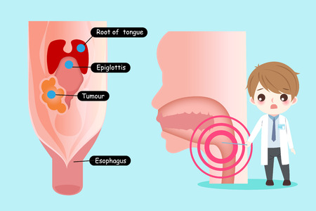 doctor with oral cancer concept on the blue backgroundのイラスト素材