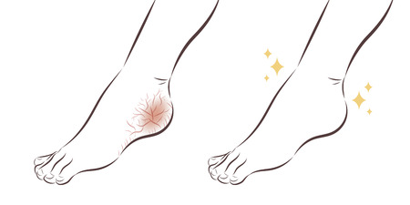 cartoon feet with dry skin before and after treatmentのイラスト素材