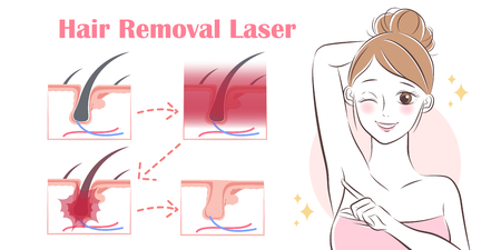 cartoon woman remove hair with laser under her armsのイラスト素材