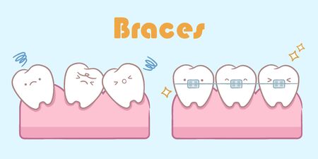 cute cartoon tooth with brace correction concept on blue backgroundのイラスト素材