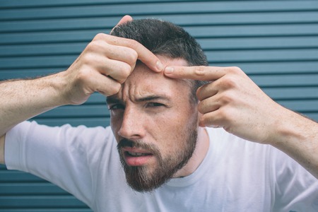 Young man is squeezing pimple on face. H is looking on camera. Isolated on striped and blue background.の写真素材