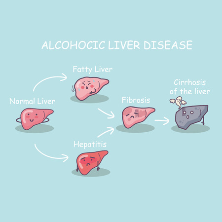 The stage of Health liver vs cirrhosis liver, great for health care conceptのイラスト素材