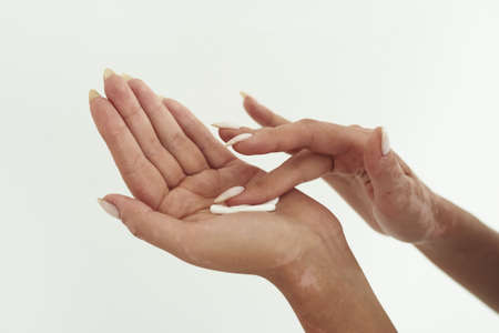 Young woman with vitiligo distributes hand cream and dips her finger into the lotion.の写真素材