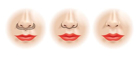 scheme correction of the upper lip. plastic surgeryの写真素材