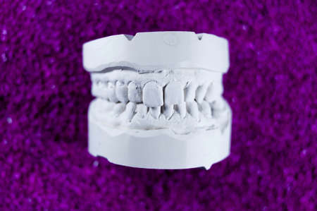 Dental impression of the upper and lower jawの写真素材