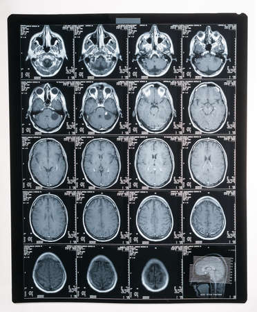 Magnetic resonance imaging, MRI, computed tomography, x-ray image. Head with brain in lateral cross-sectionの写真素材