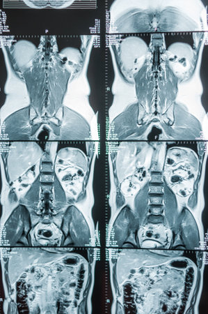 Magnetic resonance imaging, MRI, computed tomography, x-ray image. Abdominal area in cross section area of ââthe pelvis with kidneys infected with tumorsの写真素材