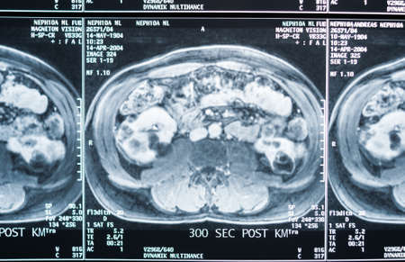 Magnetic resonance imaging, MRI, computed tomography, x-ray image. Abdominal area in cross section...