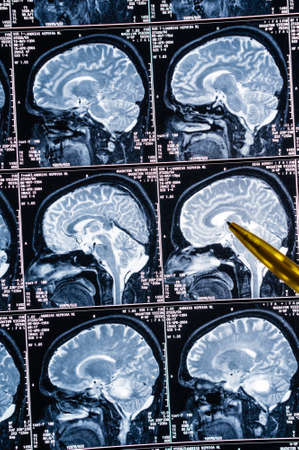 Magnetic resonance imaging, MRI, computed tomography, x-ray image. Head with brain in lateral...