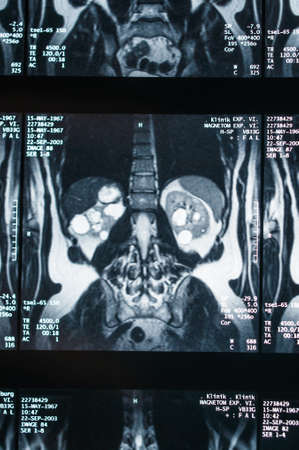 Magnetic resonance imaging, MRI, computed tomography, x-ray image. Area of ââthe pelvis with kidneys infected with tumorsの写真素材