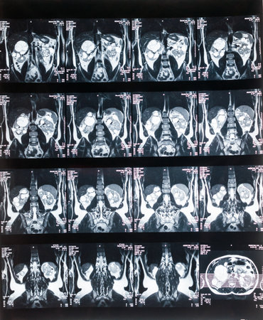 Magnetic resonance imaging, MRI, computed tomography, x-ray image. Area of ââthe pelvis with kidneys infected with tumorsの写真素材
