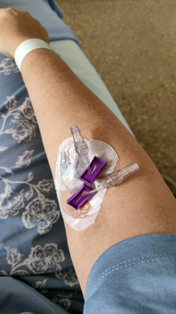 A patient receives medical attention in a healthcare facility. An intravenous catheter is attached...