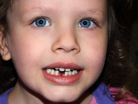 young girl with blue eyes showing her missing teethの写真素材