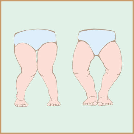  Genu varum, genu valgum - a physical legs deformity, bowing of  the leg in relation to the thighのイラスト素材