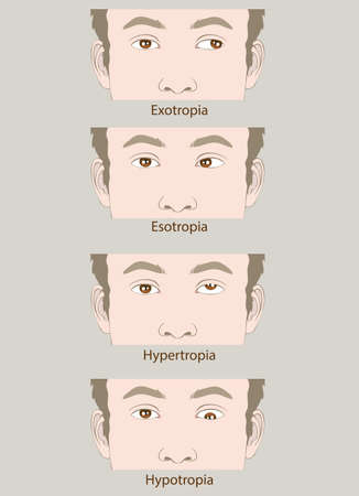 strabismus defect Esotropia, Exotropia, Hypertropia, Hypotropiaのイラスト素材