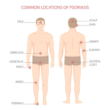 Psoriasis illness diagram, human body skin disease,のイラスト素材