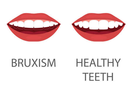 Vector illustration of bruxism. grinding of teeth. tooth appliance. dental care. dentistry health problem.のイラスト素材