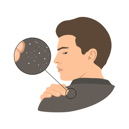 Dandruff issue on man's shoulder. Close up view. Vector illustration.のイラスト素材