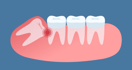 A wisdom tooth grows, flat color illustration. Impacted wisdom tooth for dentistry and dental surgery in flat style vector illustratioのイラスト素材