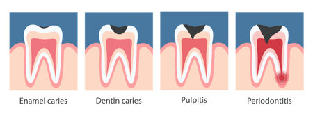 Caries development stages. Dentistry concept. Infographics. Tooth decay. Dental service. Banner, poster. Sick tooth. Vector illustrationのイラスト素材