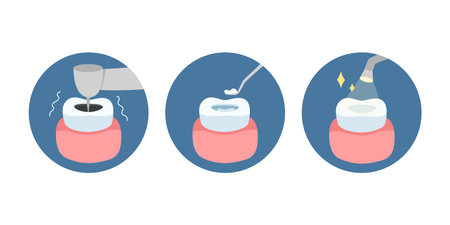 Root canal treatment process, dental treatment. Infographics for dentistryのイラスト素材