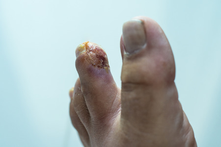 Finger on the leg. Purulent wound on the leg. Eczema. Dermatitis. Psoriasisの写真素材