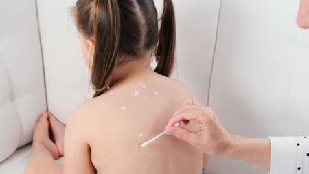 Little girl with chickenpox, antiseptic cream applied to rash. Female hands applying cream on little girl with chicken pox at home.の写真素材
