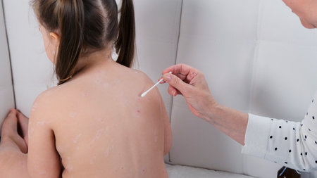 Female back treats girl with chickenpox, antiseptic cream applied to the rash. Rash period. Symptoms...